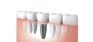 10 Essential Tips for Successful Dental Implants